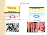 Венозный тромбоэмболизм (ТГВ, ТЭЛА). Венозные тромбозы. Атеротромбоз (ОИМ, ОНМК, ишемия сосудов ног…). Артериальные тромбозы. Гиперактивность тромбоцитов + повреждение стенки сосуда + стаз. Тромбозы Вавилова Т.В., 2008. Гиперкоагуляция + повреждение стенки сосуда + стаз