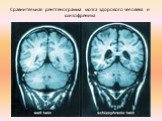 Сравнительная рентгенограмма мозга здорового человека и шизофреника