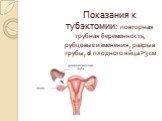 Показания к тубэктомии: повторная трубная беременность, рубцовые изменения, разрыв трубы, d плодного яйца >3 см