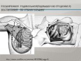 Расширенная радикальная(подмышечно-грудинная) мастэктомия по урбану-холдину. http://www.studfiles.ru/preview/6010284/page:5/