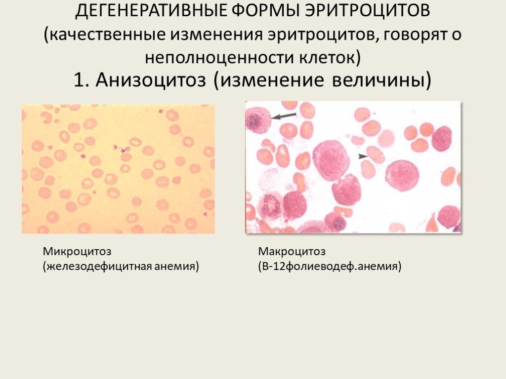 Анизоцитоз в общем анализе крови. Микроцитоз макроцитоз анизоцитоз. Анизоцитоз микроцитоз анемия. Железодефицитная анемия анизоцитоз. Анизоцитоз пойкилоцитоз гипохромия.