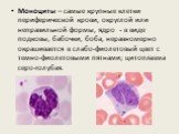 Моноциты – самые крупные клетки периферической крови, округлой или неправильной формы, ядро - в виде подковы, бабочки, боба, неравномерно окрашивается в слабо-фиолетовый цвет с темно-фиолетовыми пятнами; цитоплазма серо-голубая.