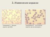 3. Изменение окраски. Гипохромия Э. – бледная окраска, при ЖДА. Гиперхромия Э. – интенсивная окраска, при витаминодеф.а.