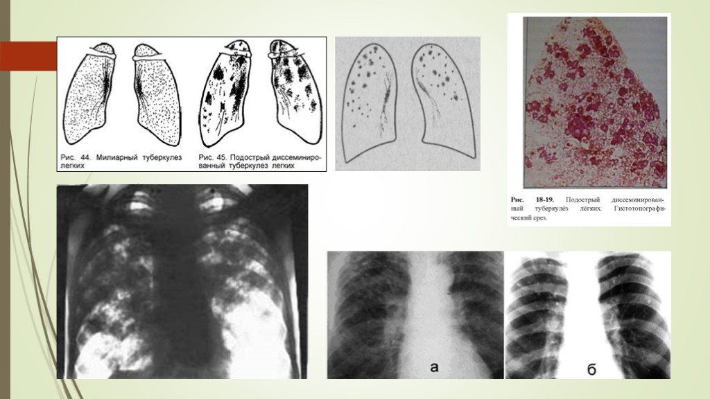 Прогрессирование туберкулеза. Милиарный туберкулез синдромы. Хронический диссеминированный туберкулез легких кт. Милиарный диссеминированный туберкулез рентген. Подострый диссеминированный туберкулез рентген.