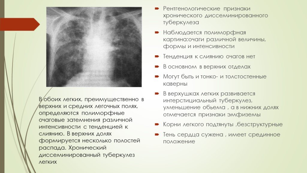 Туберкулез на латинском. Рентген признаки хронического диссеминированного туберкулеза. Подострый диссеминированный туберкулез рентген. Диссеминированный туберкулез в стадии распада. Диссеминированный туберкулез в фазе распада.