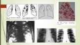 Дифференциальная диагностика подострого и хронического диссеминированного туберкулеза Слайд: 10