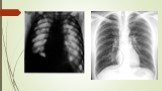 Дифференциальная диагностика подострого и хронического диссеминированного туберкулеза Слайд: 13