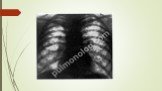Дифференциальная диагностика подострого и хронического диссеминированного туберкулеза Слайд: 19