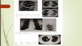 Дифференциальная диагностика подострого и хронического диссеминированного туберкулеза Слайд: 8