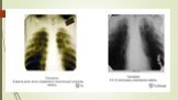 Дифференциальная диагностика подострого и хронического диссеминированного туберкулеза Слайд: 9