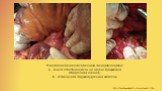 Макроскопические признаки панкреонекроза: а - очаги стеатонекроза на корне брыжейки ободочной кишки; б - изменения поджелудочной железы. http://garbuzenko62.ru/pankreatit.htm
