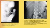 На рентгенограмме видна обструкция ободочной кишки в результате сдавления при панкреатите. На обзорном рентгенографическом снимке органов брюшной полости стрелками обозначены контуры поджелудочной железы с кальцификатами, что часто обнаруживается при алкогольном панкреатите