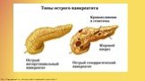http://bezpankreatita.ru/simptomy/ostryj-pankreatit-simptomy.html