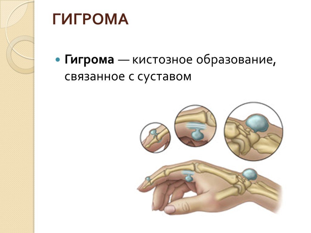 Болезни суставов презентация