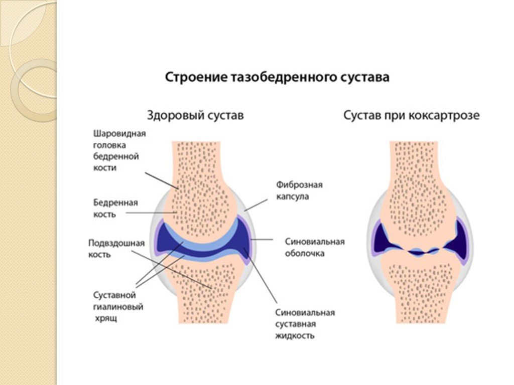 Диагноз суставы. Синовиальная жидкость в тазобедренном суставе. Синовиальная оболочка тазобедренного сустава.