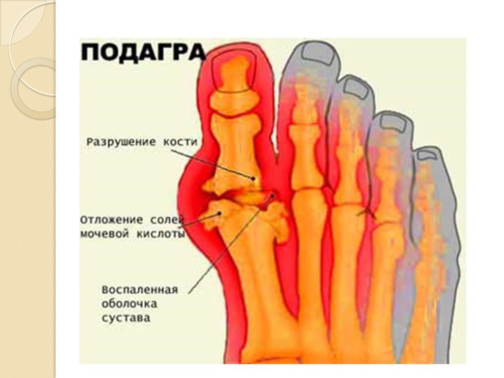 Отложение солей в суставах фото