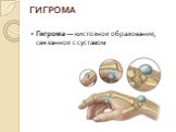 ГИГРОМА. Гигрома — кистозное образование, связанное с суставом