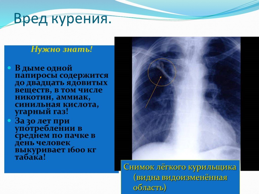Можно курить перед кт. Рентген лёгких курящего. Флюорография курильщика. Рентген легких курящих. Легкие курильщика на флюорографии.