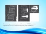 Неполный взрывной перелом тела L3-позвонка (А 3.1). Выполнена стабилизация костным материалом и пластиной GoldenGate TM .