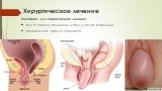 Хирургическое лечение. Показания для оперативного лечения: III и IV степени опущения матки и стенок влагалища осложненная форма пролапса