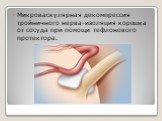 Микроваскулярная декомпрессия тройничного нерва-изоляция корешка от сосуда при помощи тефлонового протектора.