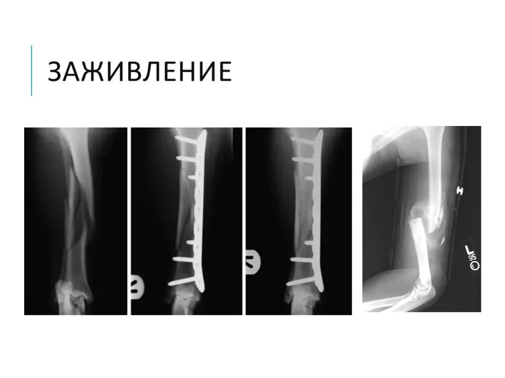 Сколько заживает перелом