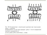 Рис. 130. Распределение жевательного давления при откусывании пищи: а - давление распределяется на две пары передних зубов; б - после шинирования давление распределяется на всю группу зубов, включенных в шину.