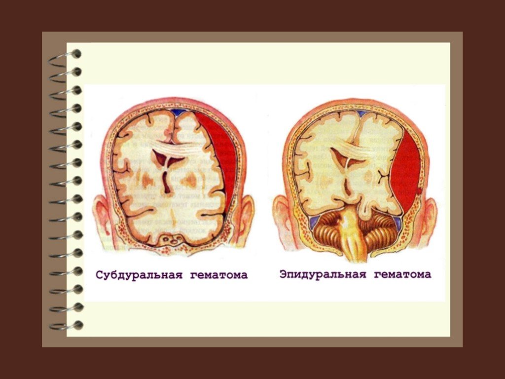 Открытая травма мозга. Субдуральная и эпидуральная гематома. Черепно-мозговая травма. Отличия субдуральной и эпидуральной гематомы. Открытая черепно-мозговая травма.