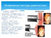 Инвазивные методы диагностики. Аспирация содержимого тонкой кишки для посева. Концентрация микроорганизмов в тонком кишечнике больше уровня 10 5 клеток/мл - убедительное доказательство в пользу наличия синдрома. Биопсия тонкой кишки. Патологические изменения в слизистой оболочке тонкого кишечника, к