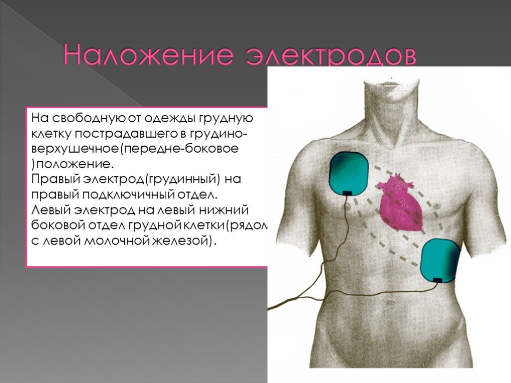 Левый электрод. Наложение электродов на грудную клетку. Электроды на грудную клетку. Схема наложения электродов на грудную клетку. Накладывание электродов на грудь.