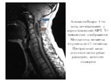Аномалия Киари 1-го типа, сочетающаяся с сирингомиелией. МРТ, Т1-взвешенное изображение. Миндалины мозжечка опущены до С1 позвонка. Центральный канал спинного мозга резко расширен, заполнен ликвором