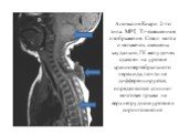 Аномалия Киари 2-го типа. МРТ, Т1-взвешенное изображение. Ствол мозга и мозжечок смещены каудально, IV желудочек сдавлен на уровне краниовертебрального перехода, почти не дифференцируется, определяются спинно-мозговая грыжа на верхнегрудном уровне и сирингомиелия
