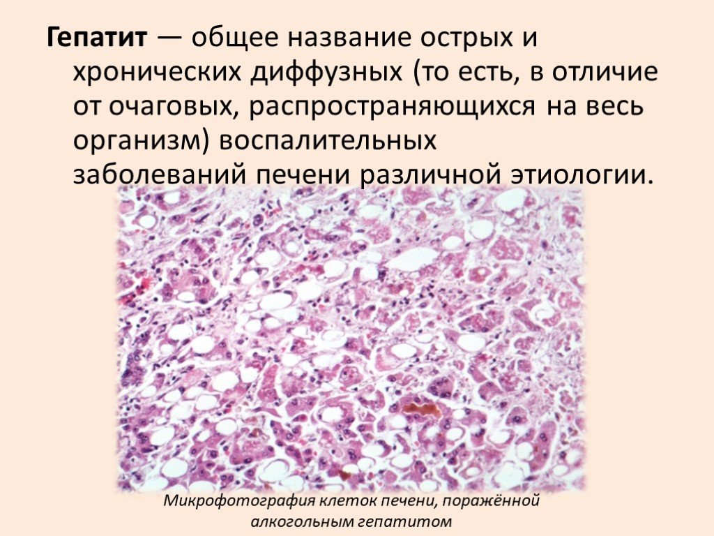 Диффузный гепатит