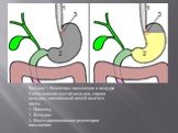Рисунок 1. Рецепторы насыщения в желудке. Слева показан пустой желудок, справа желудок, заполненный пищей желтого цвета. 1. Пищевод 2. Желудок 3. Место расположения рецепторов насыщения