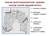 Анализ рентгенологической картины мягких тканей грудной клетки. 1 – кожная складка; 2 – большая грудная мышца; 3 – сосок; 4 – молочная железа; 5 – сопроводи- тельные полоски I-II ребра.