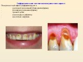 Дифференциальная диагностика поверхностного кариеса Поверхностный кариес дифференцируют с: - системной гипоплазией (бороздчатая форма); - флюорозом (эрозивная форма); - эрозией зубов; - клиновидным дефектом; - кислотным некрозом.