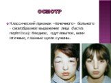Классический признак «почечного» больного – своеобразное выражение лица (facies nephritica): бледное, одутловатое, веки отечные, глазные щели сужены.