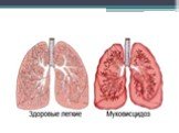 Наследственные хронические неспецифические заболевания лёгких Слайд: 46