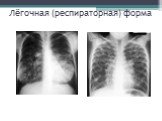 Наследственные хронические неспецифические заболевания лёгких Слайд: 54