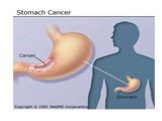Рак желудка - диагностика и лечение Слайд: 14