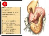 Мобилизация желудка : пересечение a. et v. gastro-epiploica dextra. 1 — a. et v. gastro-epiploica sinistra; 2 — lig. gastro-colicum; 3 — pancreas; 4 — a. et v. gastro-epiploica dextra; 5 — ventriculus. 3
