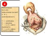 Мобилизация желудка : пересечение ветвей a. et v. gastroduodenalis. 1 — ventriculus; 2 — pancreas; 3 — a. et v. gastro-duodenalis; 4 — a. et v. gastro-epiploica dextra. 4