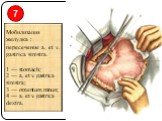 Мобилизация желудка : пересечение а. et v. gastrica sinistra. 1 — stomach; 2 — a. et v. gastrica sinistra; 3 — omentum minus; 4 — a. et v. gastriсa dextra. 7