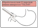 Обработка культи 12-перстной кишки аппаратом “УКЛ-60”.