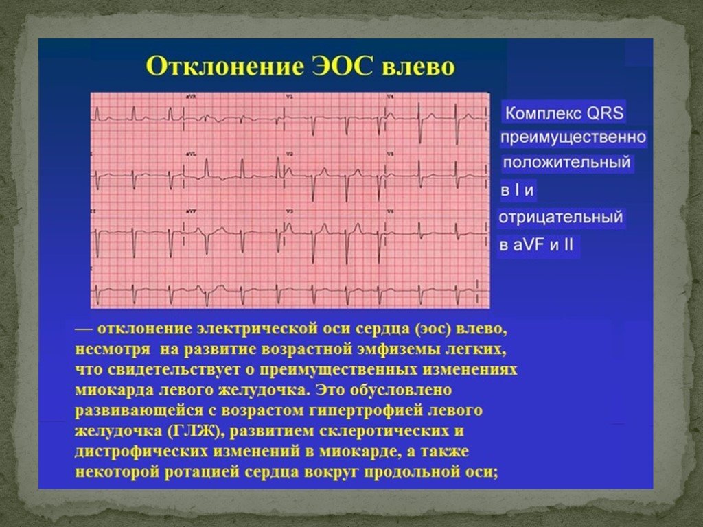 Сердце отклонено вправо. Отклонение параметров QRS. Отклонение параметров QRS на ЭКГ. Кардиограмма с отклонениями. Что такое отклонение параметров QRS В кардиограмме.