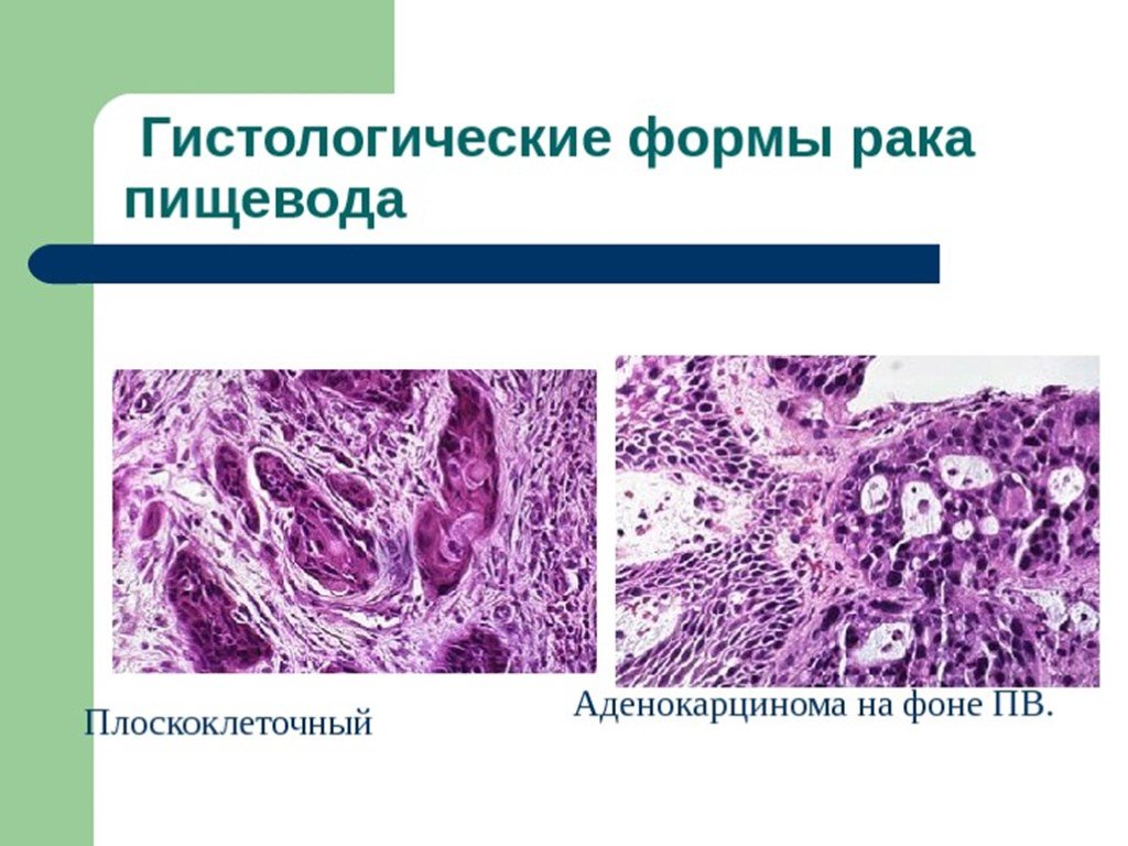 Гистологическая картина плоскоклеточного рака