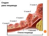 Рак пищевода: Диагностика и стадирование. Слайд: 23