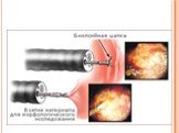 Рак пищевода: Диагностика и стадирование. Слайд: 6