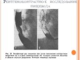 Рентгеноконтрастное исследование пищевода