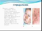 Определение. Рожа (англ. еrysipelas) — инфекционная болезнь человека, вызываемая β-гемолитическим стрептококком группы А и протекающая в острой (первичной) или хронической (рецидивирующей) форме с выраженными симптомами интоксикации и очагового серозного или серозно-геморрагического воспаления кожи 